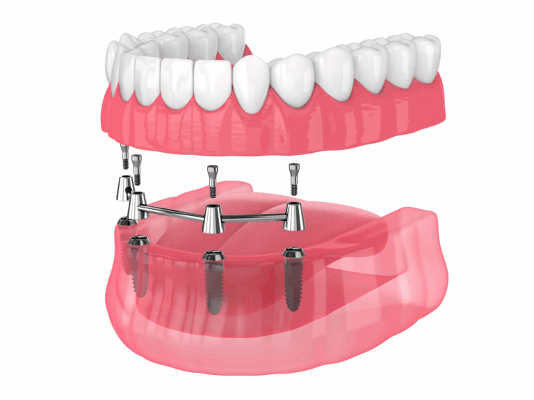 Image of a dental implant system consisting of a full set of artificial teeth (denture) supported by four metal posts surgically placed into the upper jawbone. The metal framework connects the implants to the denture, providing a stable and secure fit.