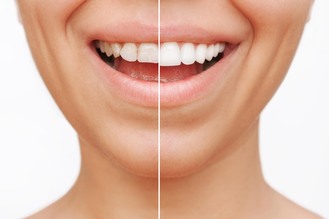Close-up of teeth at Quest Dental showing a split view, with one side discolored and the other side brightened by veneers.